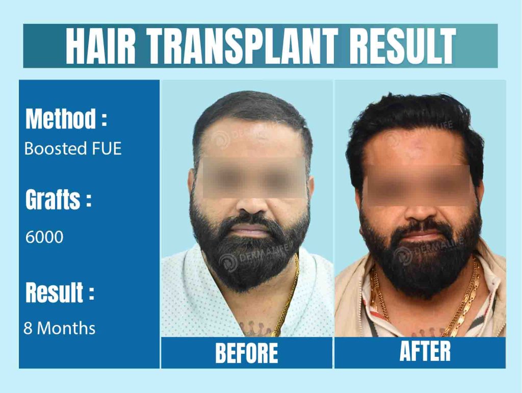 Hair Transplant Scars: Myth vs. Reality